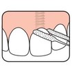 TePe Bridge & Implant Floss Οδοντικό Νήμα με Σπογγώδες Τμήμα, Κατάλληλο για Καθαρισμό των Εμφυτευμάτων & Γεφυρών 30 pcs