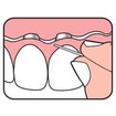 TePe Bridge & Implant Floss Οδοντικό Νήμα με Σπογγώδες Τμήμα, Κατάλληλο για Καθαρισμό των Εμφυτευμάτων & Γεφυρών 30 pcs